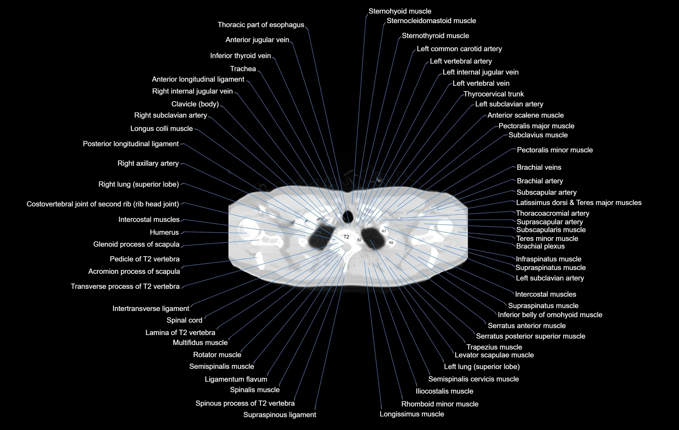 CT chest (thorax) lung window window labelled axial cross sectional anatomy radiology image-00009.webp